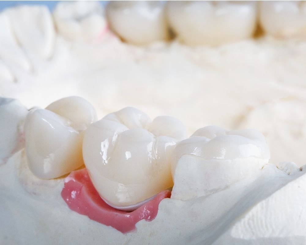 Same-day CEREC crowns at North Kamloops Dental