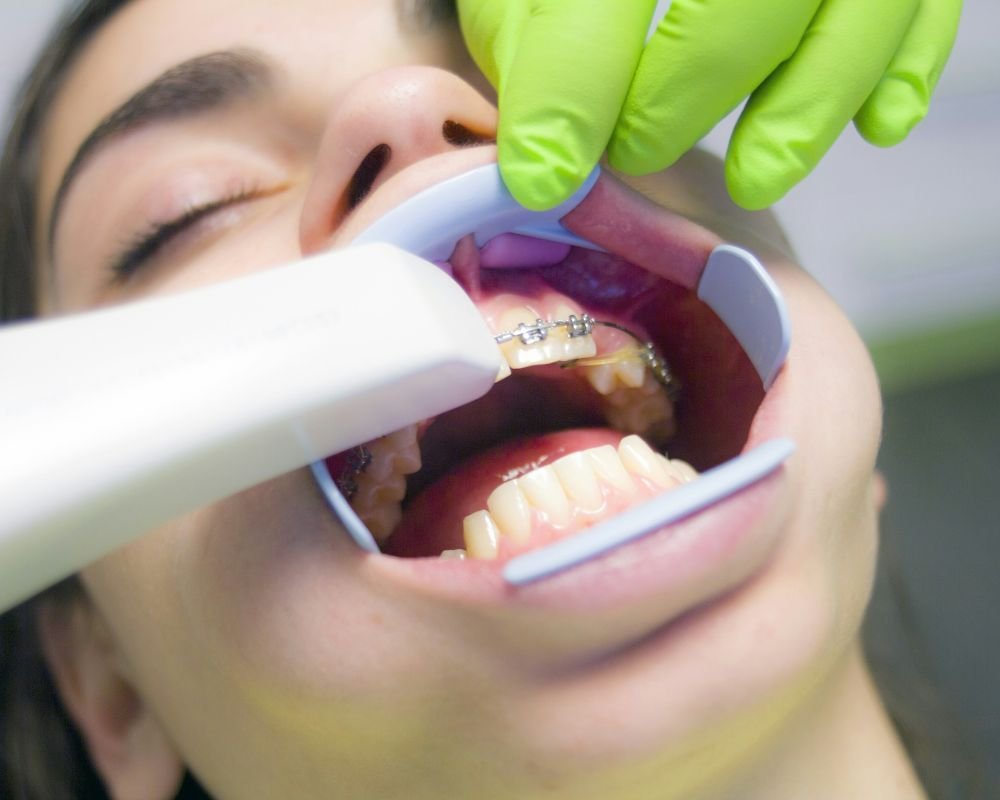 Digital Scanning with Primescan at North Kamloops Dental